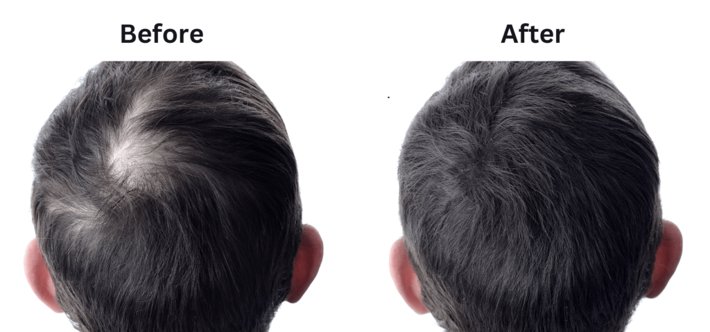 hair transplant in Pune